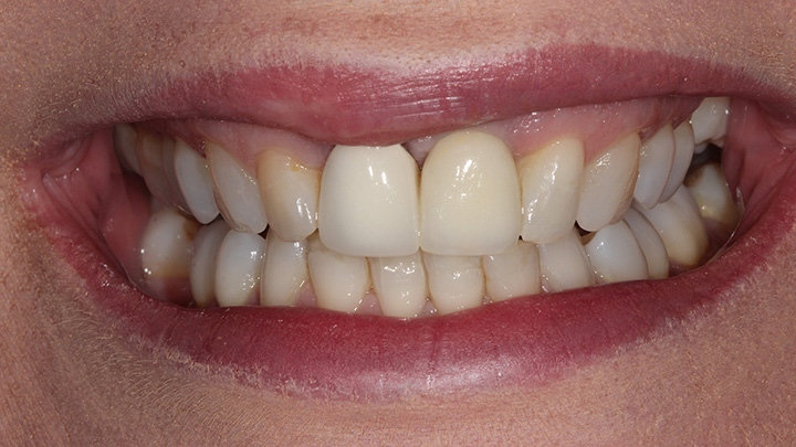 Dental implant to replace the upper left central incisor - after