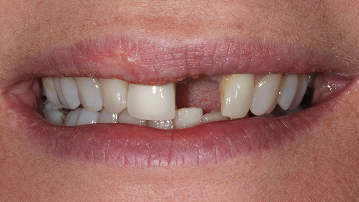 Denatl implant to replace the upper left central incisor - before
