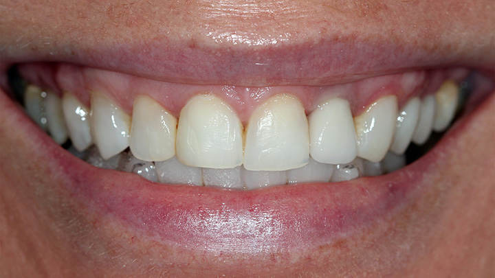 Implant to replace the upper left central incisor - after