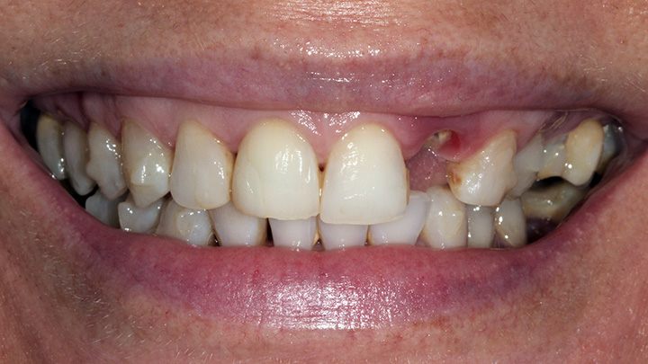Dental implant to replace the upper left central incisor - before