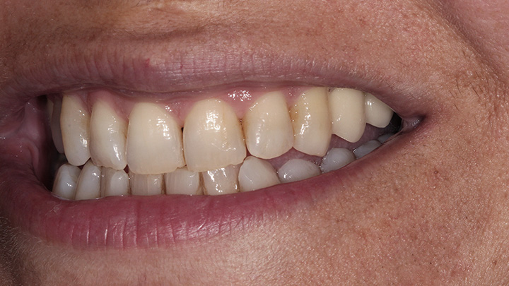 Implant to replace the upper left central incisor - after