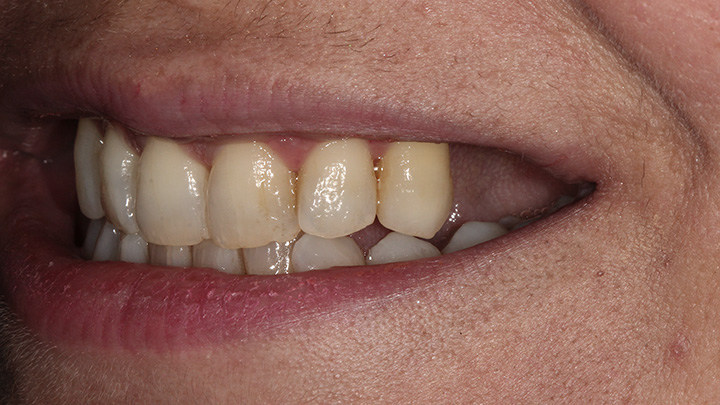 Implant to replace the upper left central incisor - before