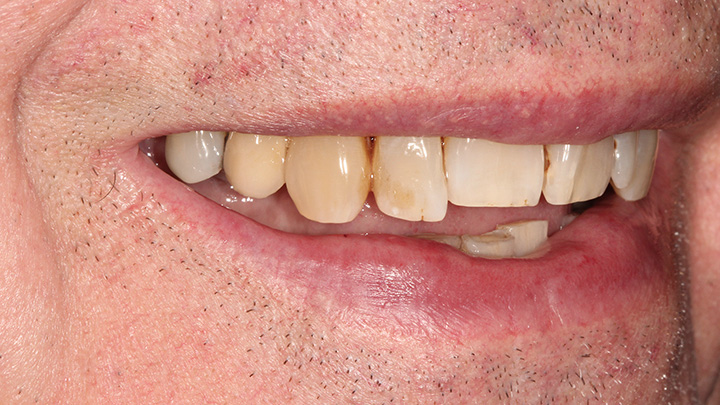 Implant to replace the upper left central incisor - after