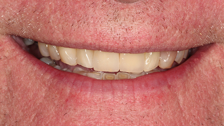 Implant to replace the upper left central incisor - after