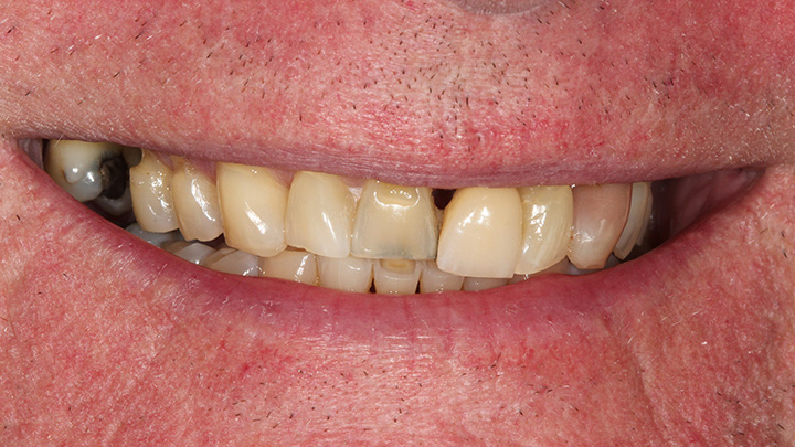 Implant to replace the upper left central incisor - before