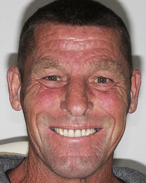 full mouth dental implant - after