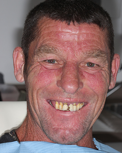 full mouth dental implant - before