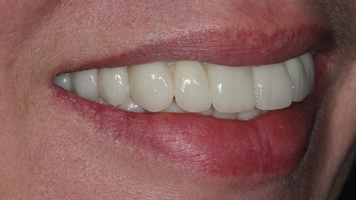 full mouth dental implant - after