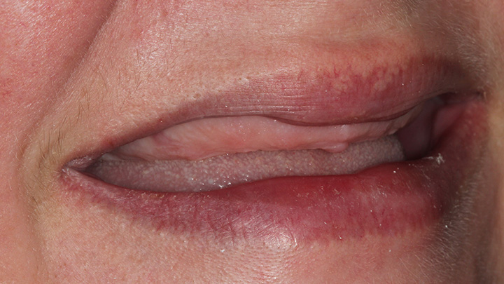 full mouth dental implant - before