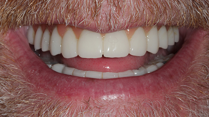 full mouth dental implant - after