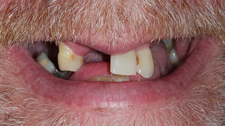 full mouth dental implant - before