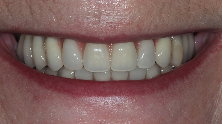 full mouth dental implant - after