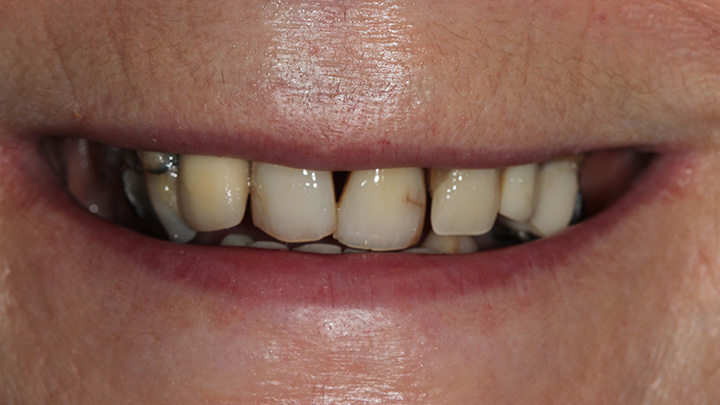 full mouth dental implant - before