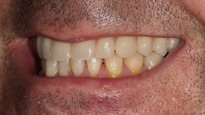 full mouth dental implant - after