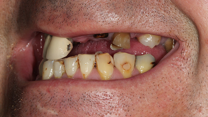 full mouth dental implant - before