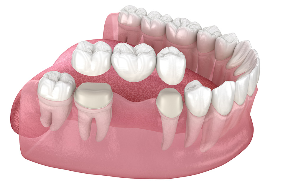 Dental bridges
