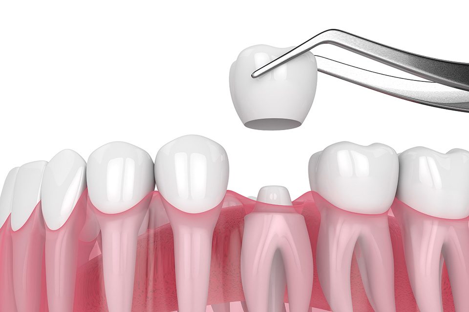 Dental crowns