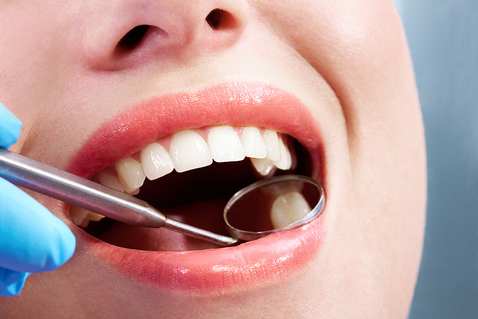 White fillings