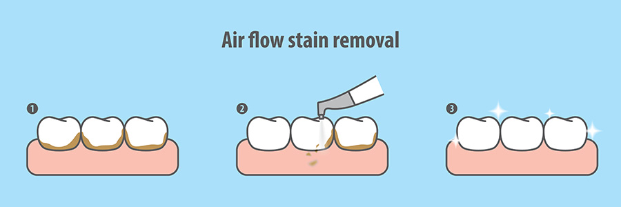 Dental hygiene treatment with Airflow Polishing