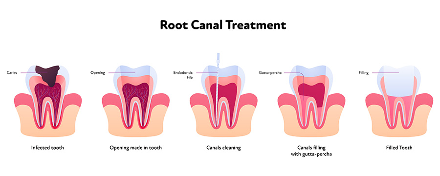 Root canal treatment