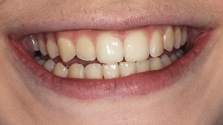 Teeth straightening - before