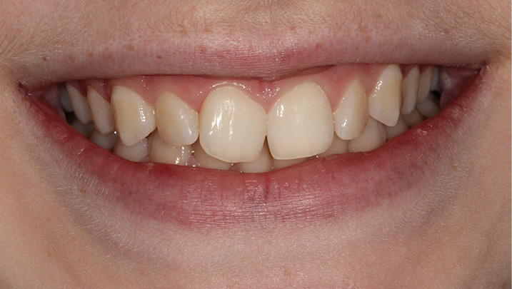 Teeth straightening - before