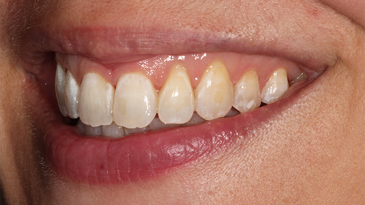 Teeth straightening - before