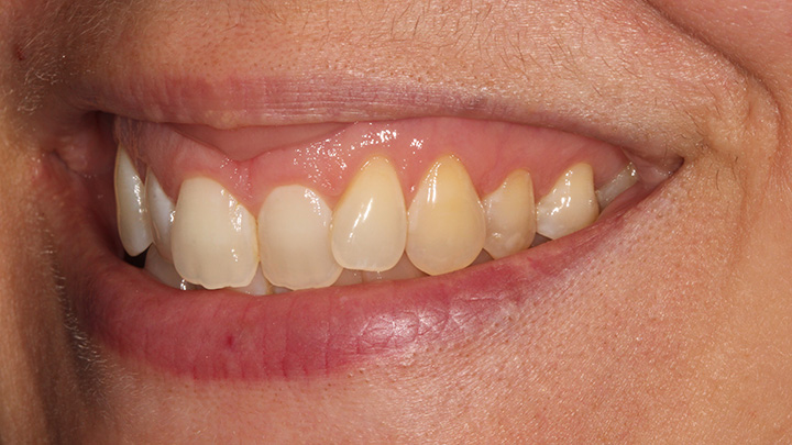 Teeth straightening - before