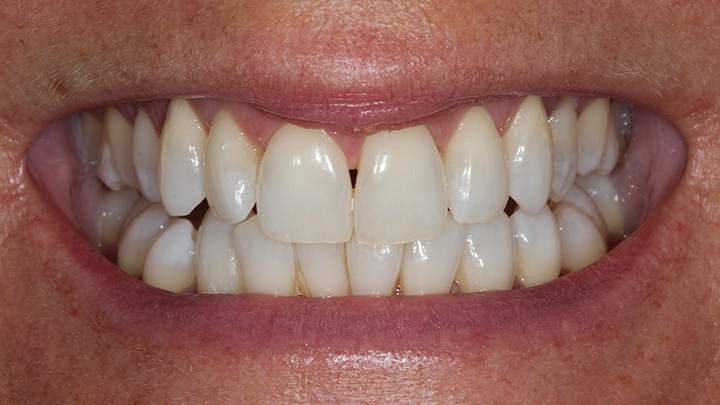Teeth whitening - before