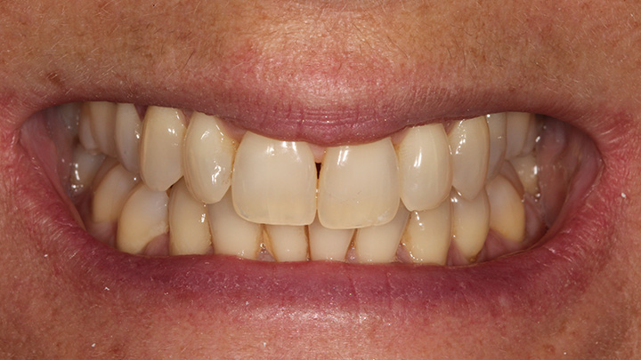 Teeth whitening - before