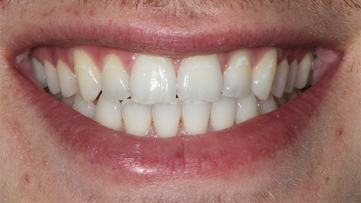 Teeth whitening - before