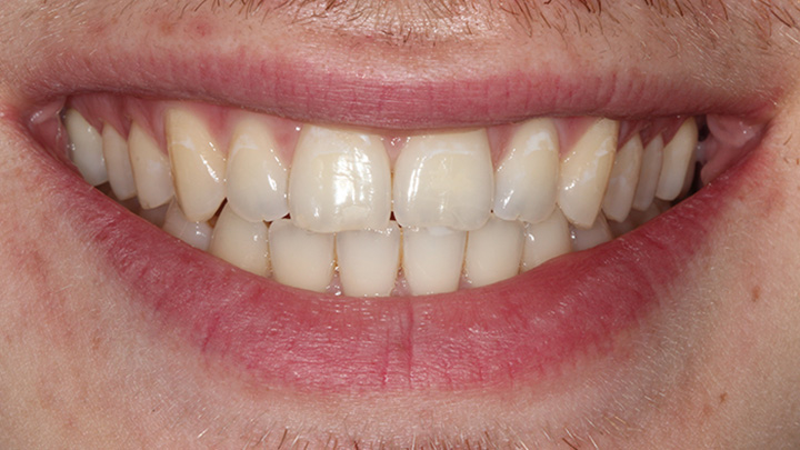 Teeth whitening - before