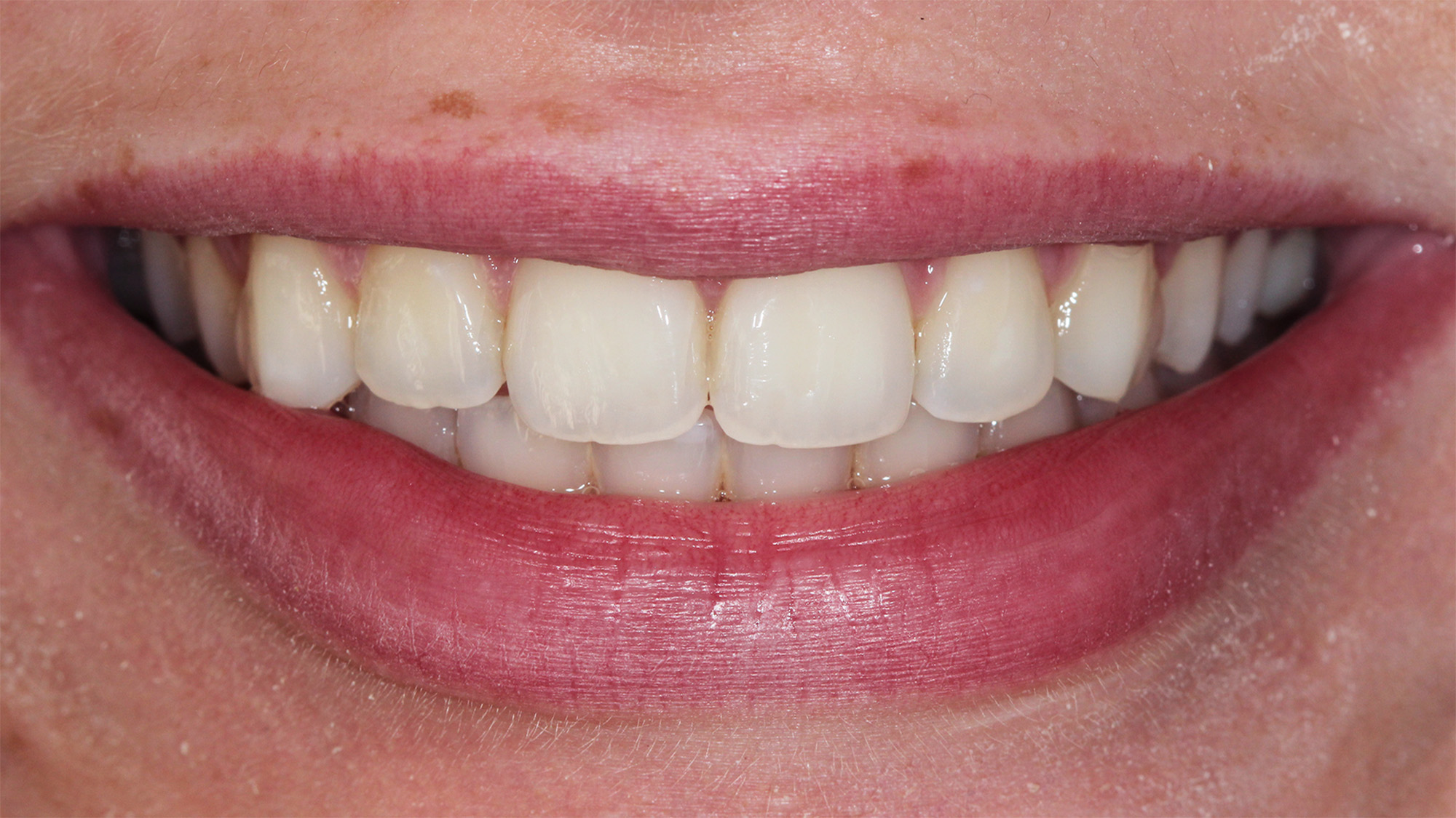 Teeth whitening - before