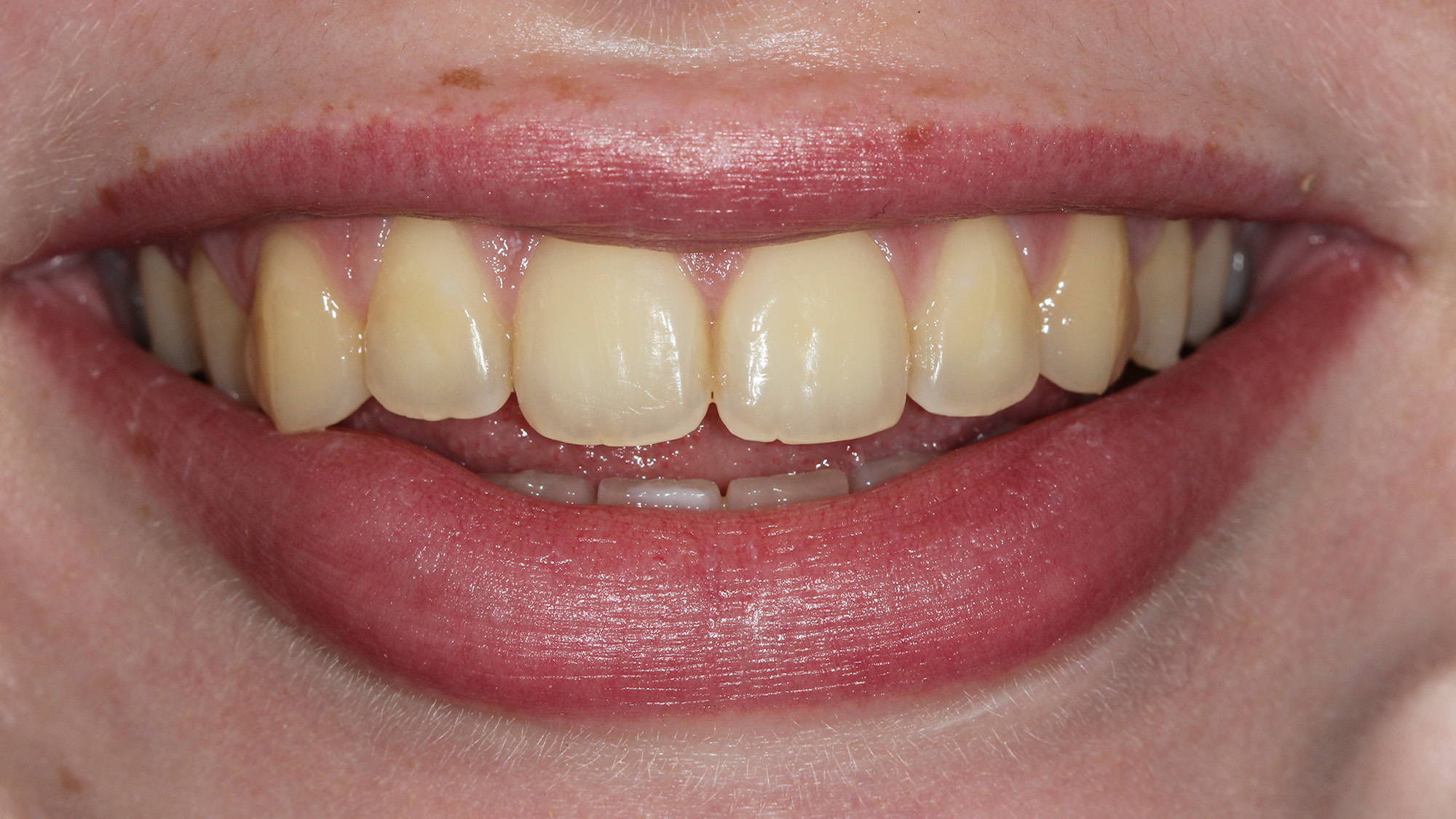 Teeth whitening - before