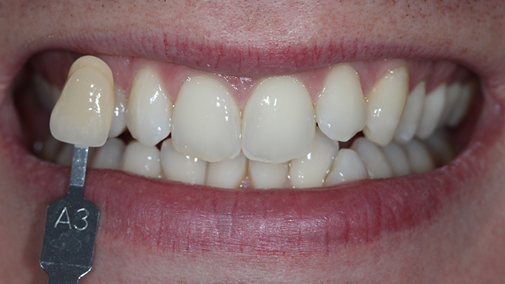 Teeth whitening - before