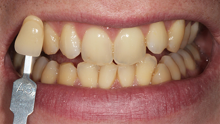 Teeth whitening - before