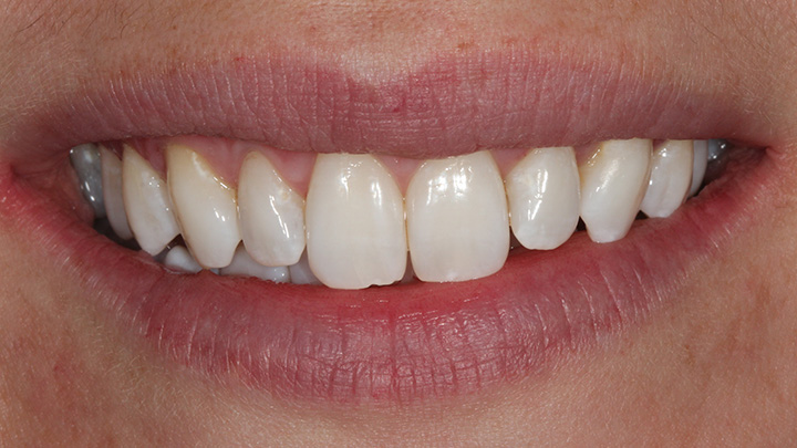 Teeth whitening - before