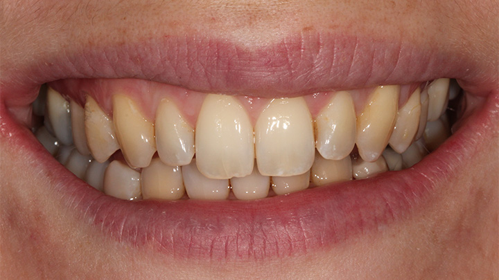 Teeth whitening - before