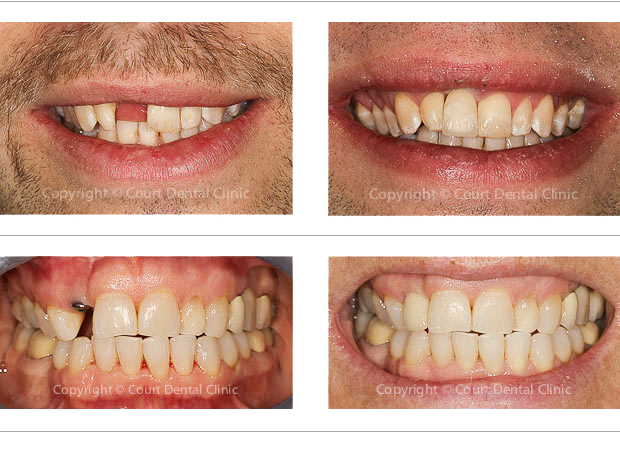Dental Implants Beaconsfield - before and after treatment