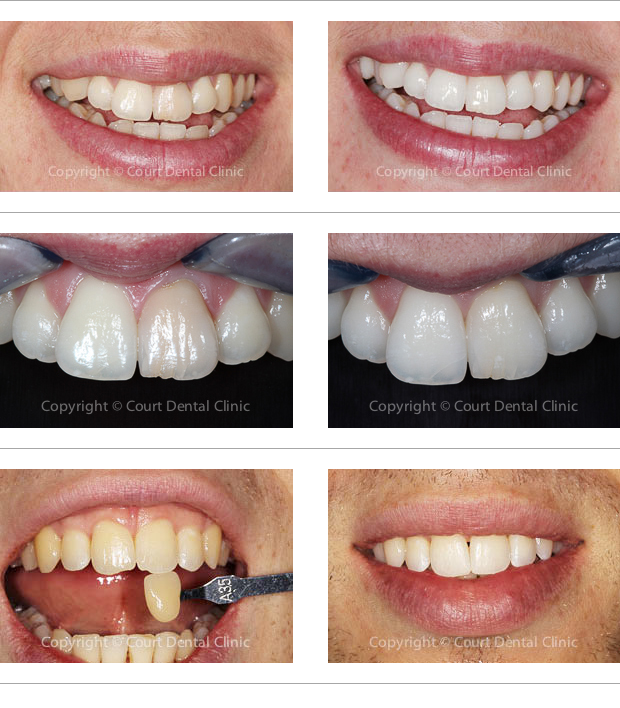 Tooth Whitening - before and after treatment at Court Dental Clinic - Beaconsfield