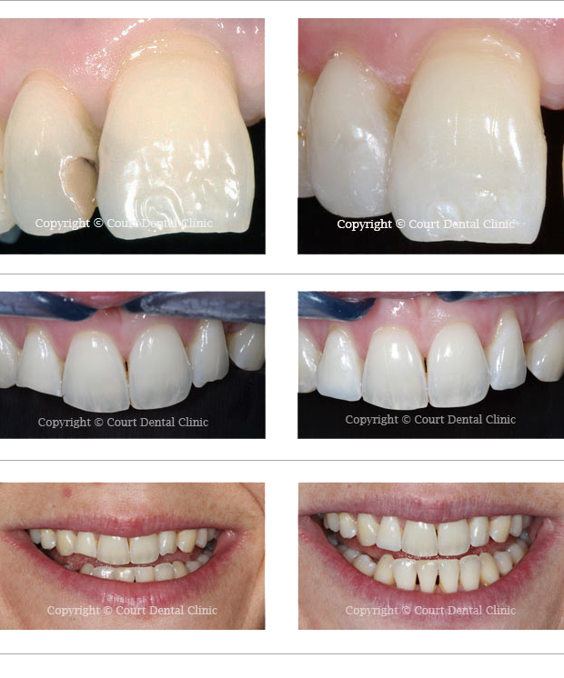 Beaconsfield Dental Practice - White Fillings - before and after treatment